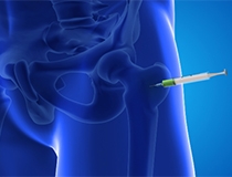 A Few Millimeters Matter: Why Image-Guided Hip Injections Can Significantly Affect Accurac...