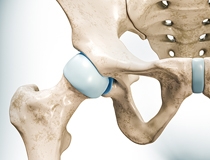 Cartilage Restoration in the Hip: Where the Science Stands, and Where It’s Going