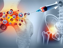 Steroid (Cortisone), PRP, or Other? Why the “Best” Hip Injection Depends on What’s A...