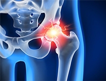 Treating Hip Labral Tears with Regenerative Medicine: What’s Possible?