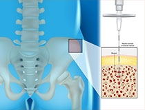 What Is BMAC and How Does It Work for Joint Healing?