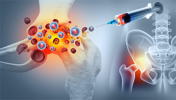 Steroid (Cortisone), PRP, or Other? Why the “Best” Hip Injection Depends on What’s Actually Causing Your Pain