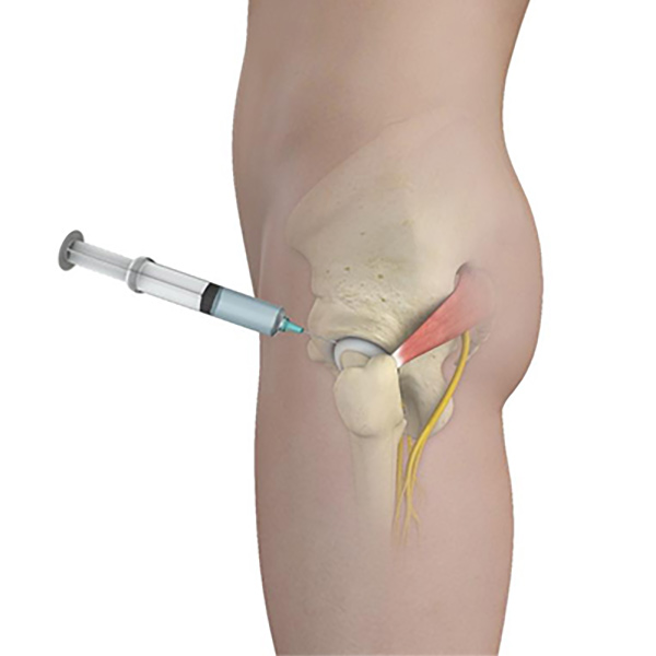 Adipose (Fat) Injections