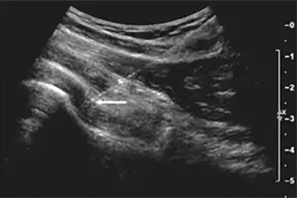 Ultrasound-Guided Injections